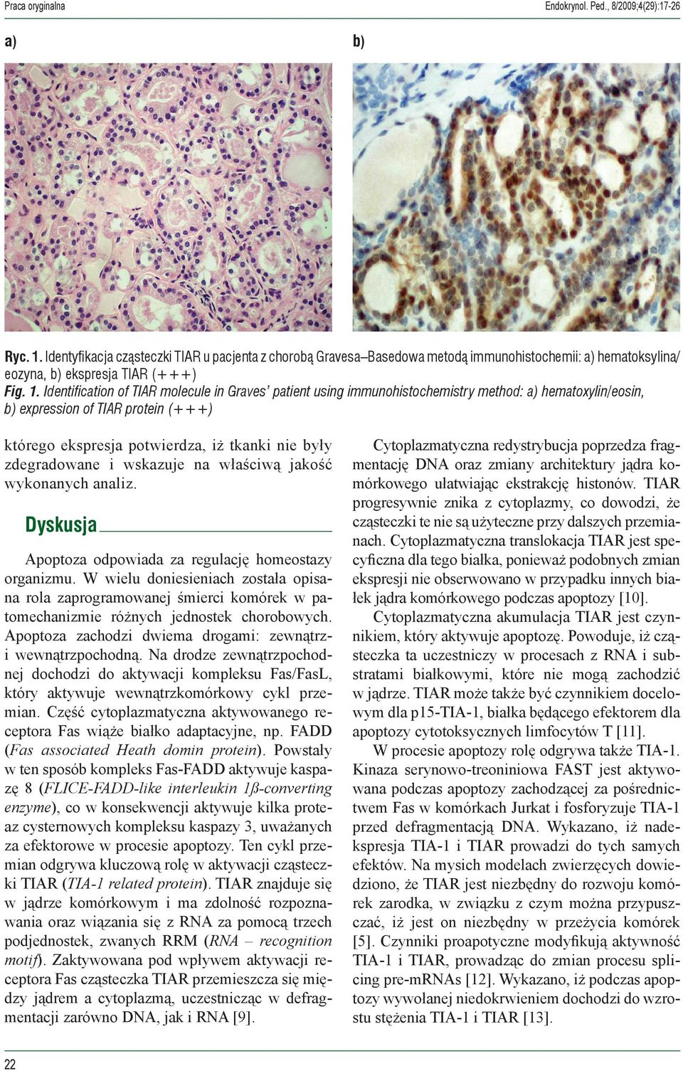 Identification of TIAR molecule in Graves patient using immunohistochemistry method: a) hematoxylin/eosin, b) expression of TIAR protein (+++) którego ekspresja potwierdza, iż tkanki nie były