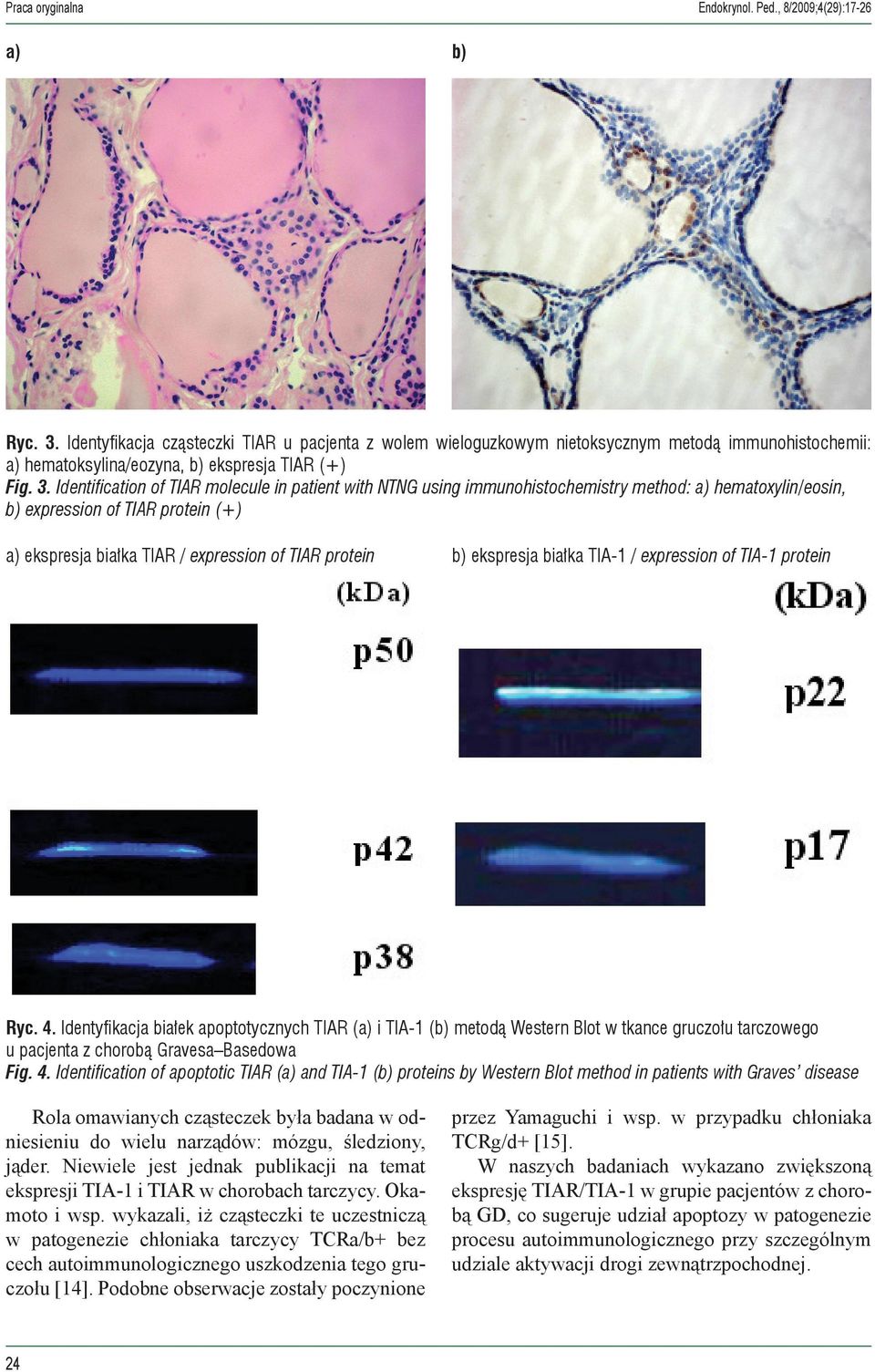 Identification of TIAR molecule in patient with NTNG using immunohistochemistry method: a) hematoxylin/eosin, b) expression of TIAR protein (+) a) ekspresja białka TIAR / expression of TIAR protein