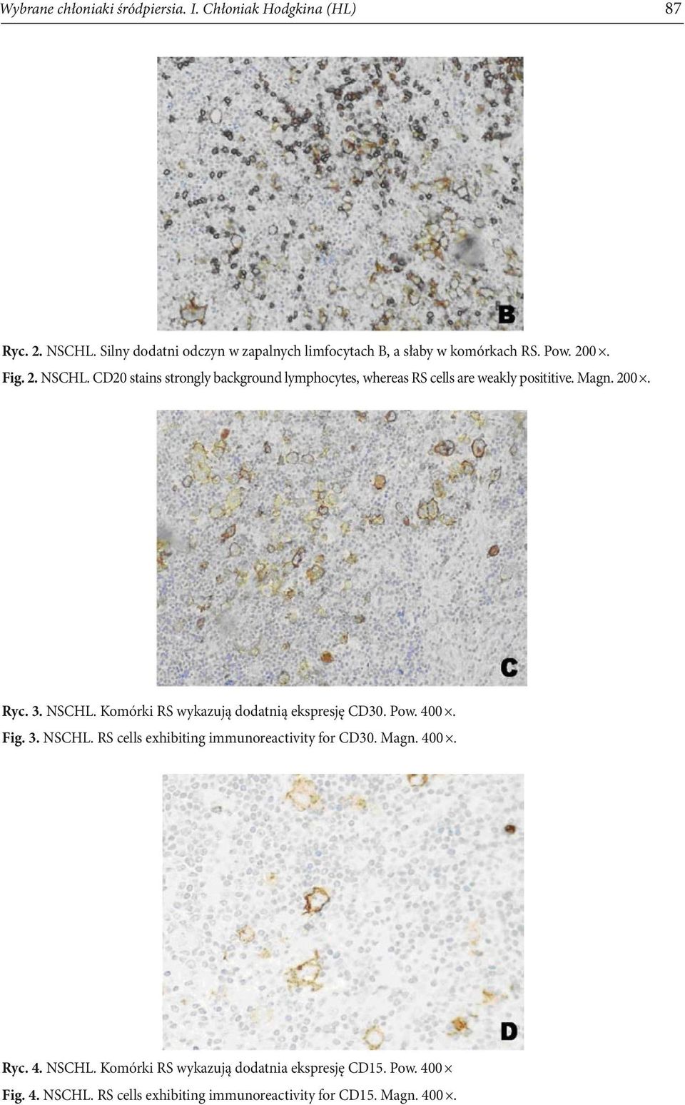 CD20 stains strongly background lymphocytes, whereas RS cells are weakly posititive. Magn. 200. Ryc. 3. NSCHL.