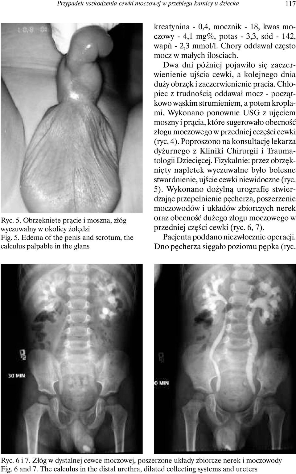 Edema of the penis and scrotum, the calculus palpable in the glans kreatynina - 0,4, mocznik - 18, kwas moczowy - 4,1 mg%, potas - 3,3, sód - 142, wapń - 2,3 mmol/l.