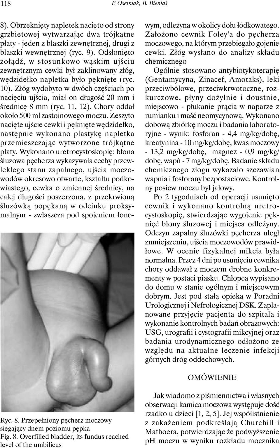 Złóg wydobyto w dwóch częściach po nacięciu ujścia, miał on długość 20 mm i średnicę 8 mm (ryc. 11, 12). Chory oddał około 500 ml zastoinowego moczu.