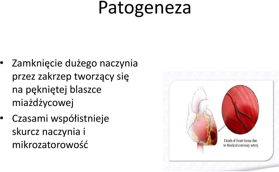 pękniętej blaszce miażdżycowej Czasami