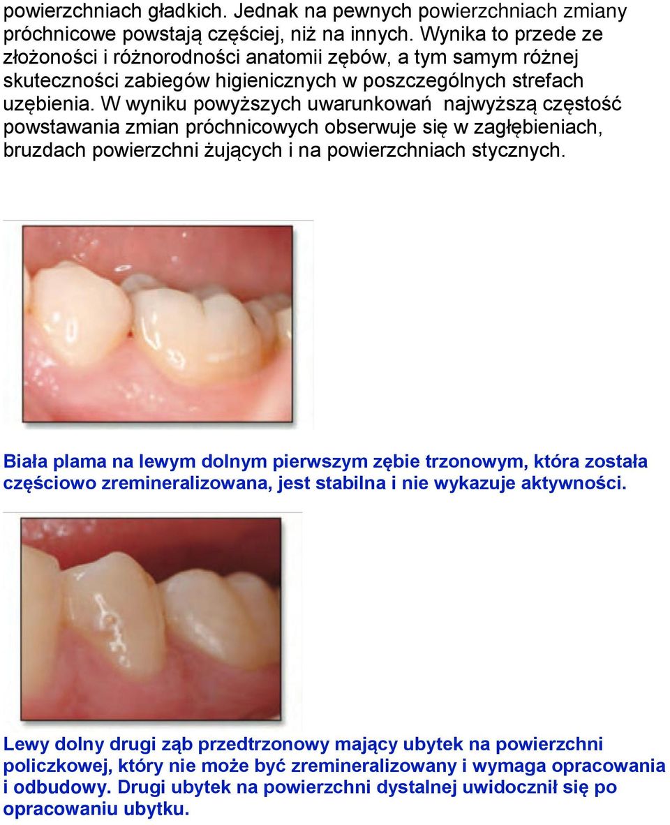 W wyniku powyższych uwarunkowań najwyższą częstość powstawania zmian próchnicowych obserwuje się w zagłębieniach, bruzdach powierzchni żujących i na powierzchniach stycznych.