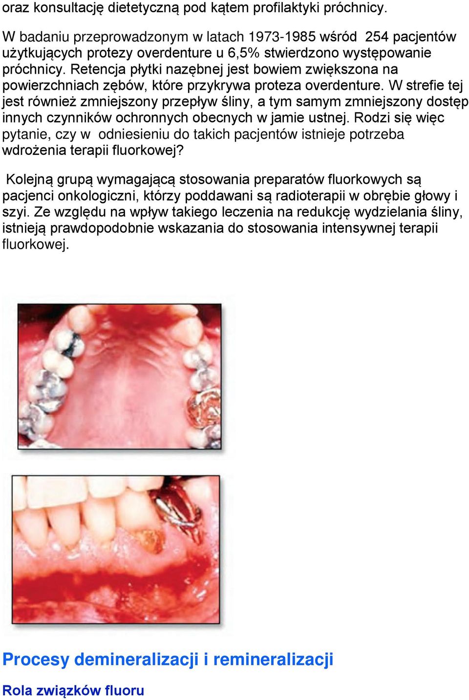 Retencja płytki nazębnej jest bowiem zwiększona na powierzchniach zębów, które przykrywa proteza overdenture.