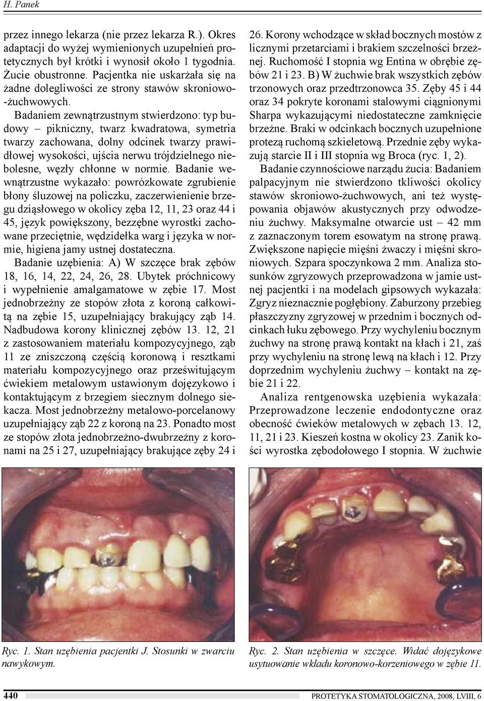 Badaniem zewnątrzustnym stwierdzono: typ budowy pikniczny, twarz kwadratowa, symetria twarzy zachowana, dolny odcinek twarzy prawidłowej wysokości, ujścia nerwu trójdzielnego niebolesne, węzły