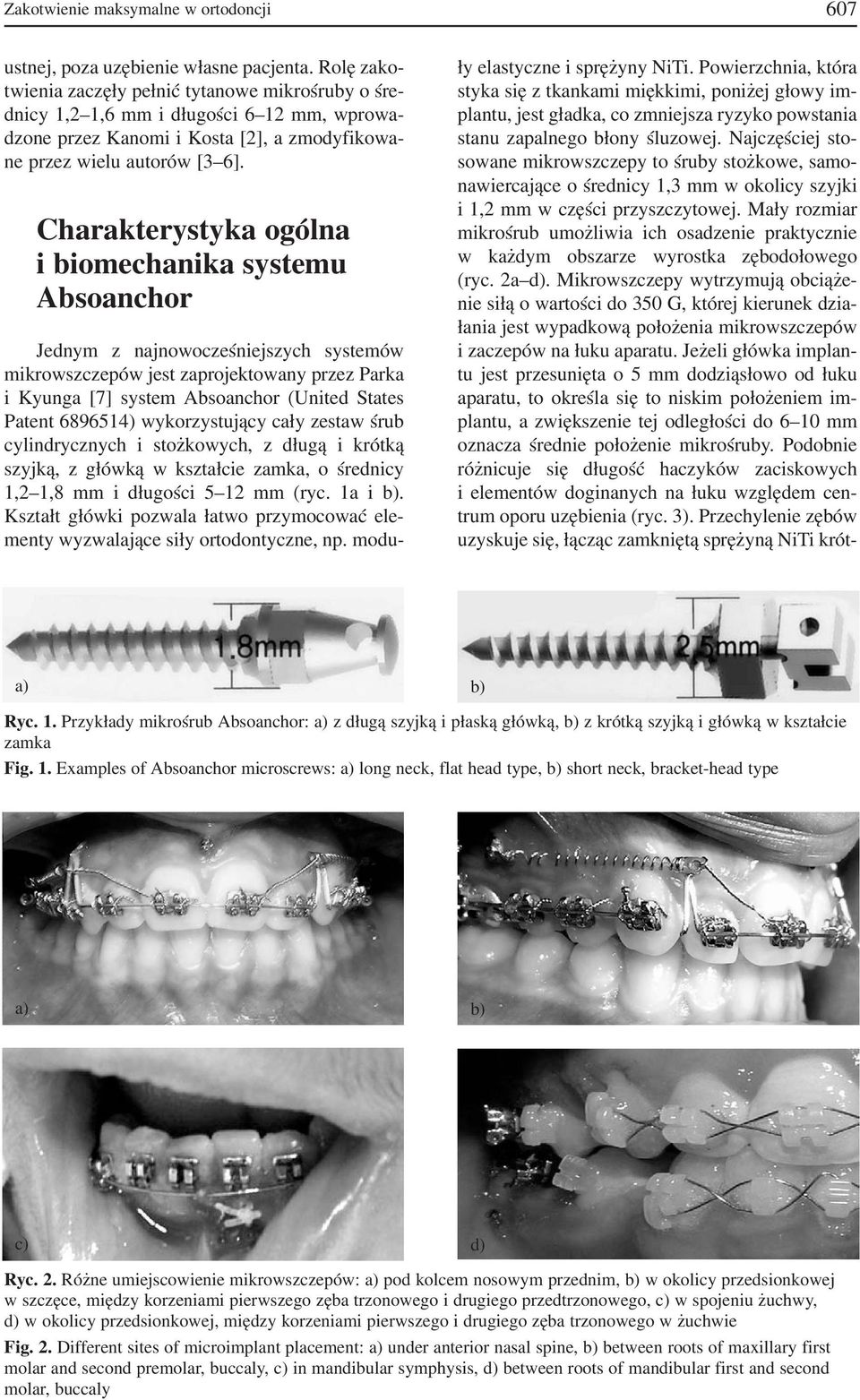 Charakterystyka ogólna i biomechanika systemu Absoanchor Jednym z najnowocześniejszych systemów mikrowszczepów jest zaprojektowany przez Parka i Kyunga [7] system Absoanchor (United States Patent
