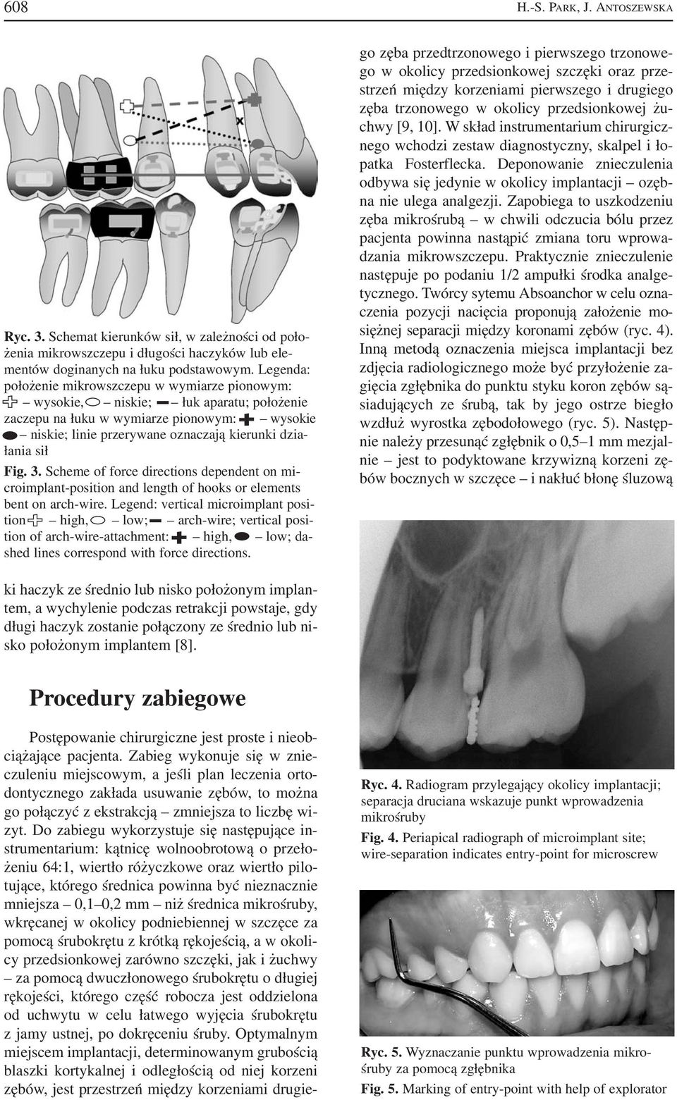 Fig. 3. Scheme of force directions dependent on mi croimplant position and length of hooks or elements bent on arch wire.