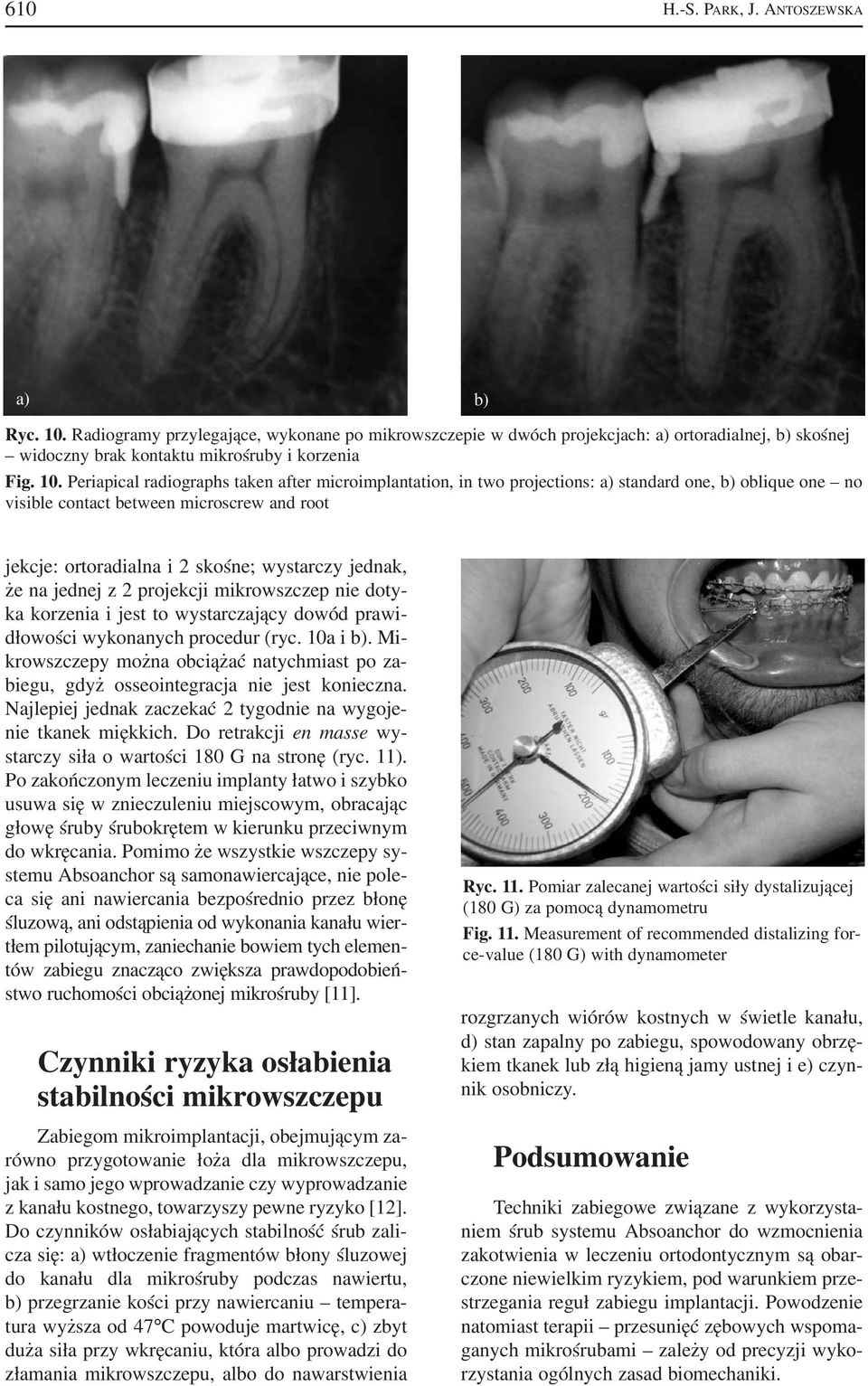 Periapical radiographs taken after microimplantation, in two projections: a) standard one, b) oblique one no visible contact between microscrew and root jekcje: ortoradialna i 2 skośne; wystarczy