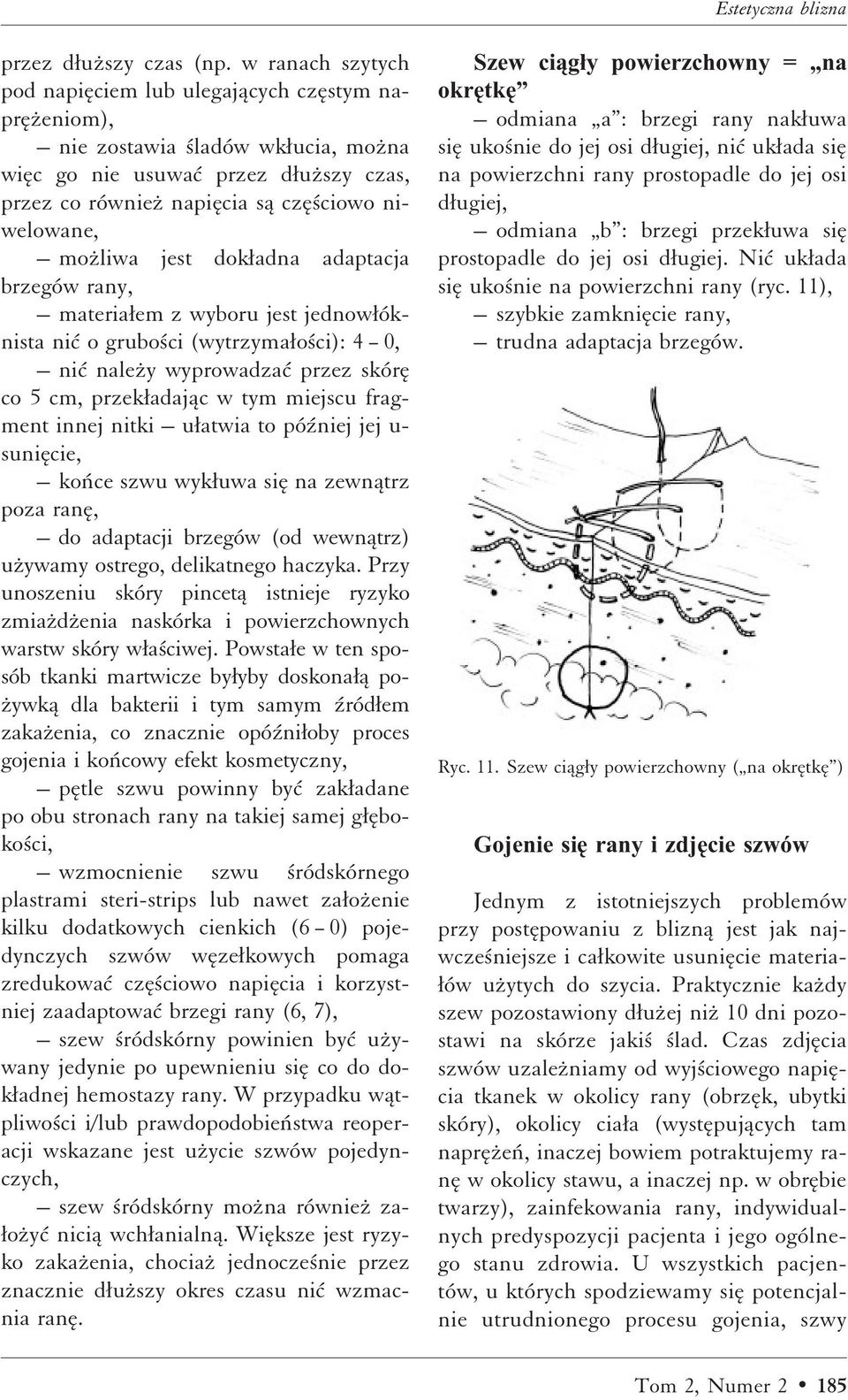 moºliwa jest dokæadna adaptacja brzegów rany, materiaæem z wyboru jest jednowæóknista niì o grubo ci (wytrzymaæo ci): 4 0, niì naleºy wyprowadzaì przez skóræ co 5 cm, przekæadajåc w tym miejscu