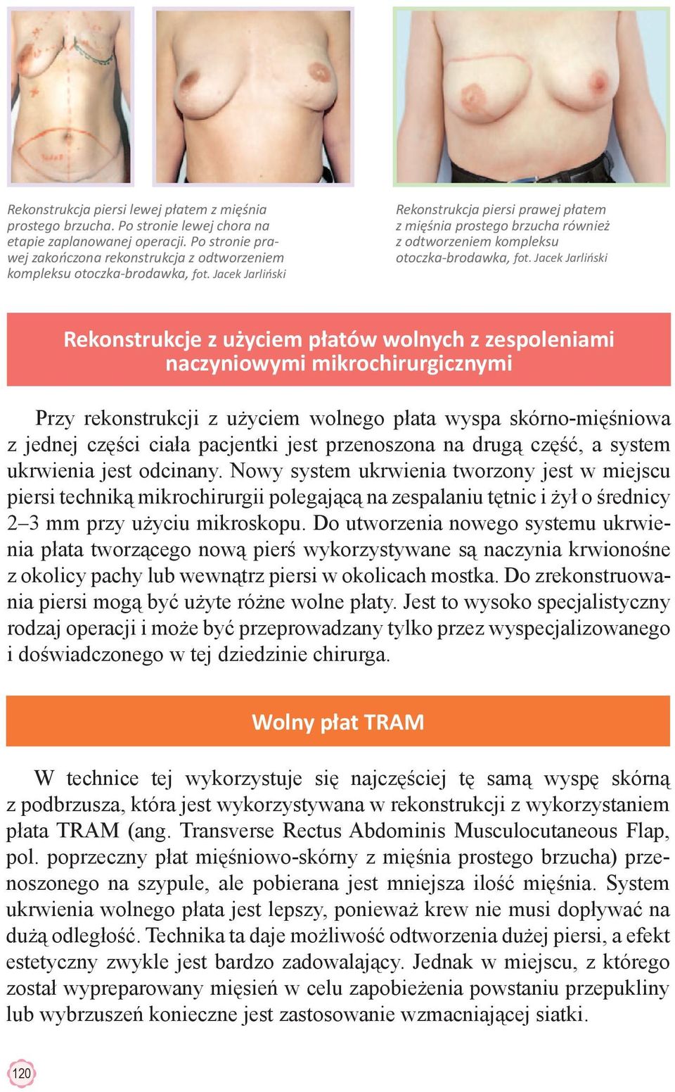 Jacek Jarliński Rekonstrukcja piersi prawej płatem z mięśnia prostego brzucha również z odtworzeniem kompleksu otoczka-brodawka, fot.