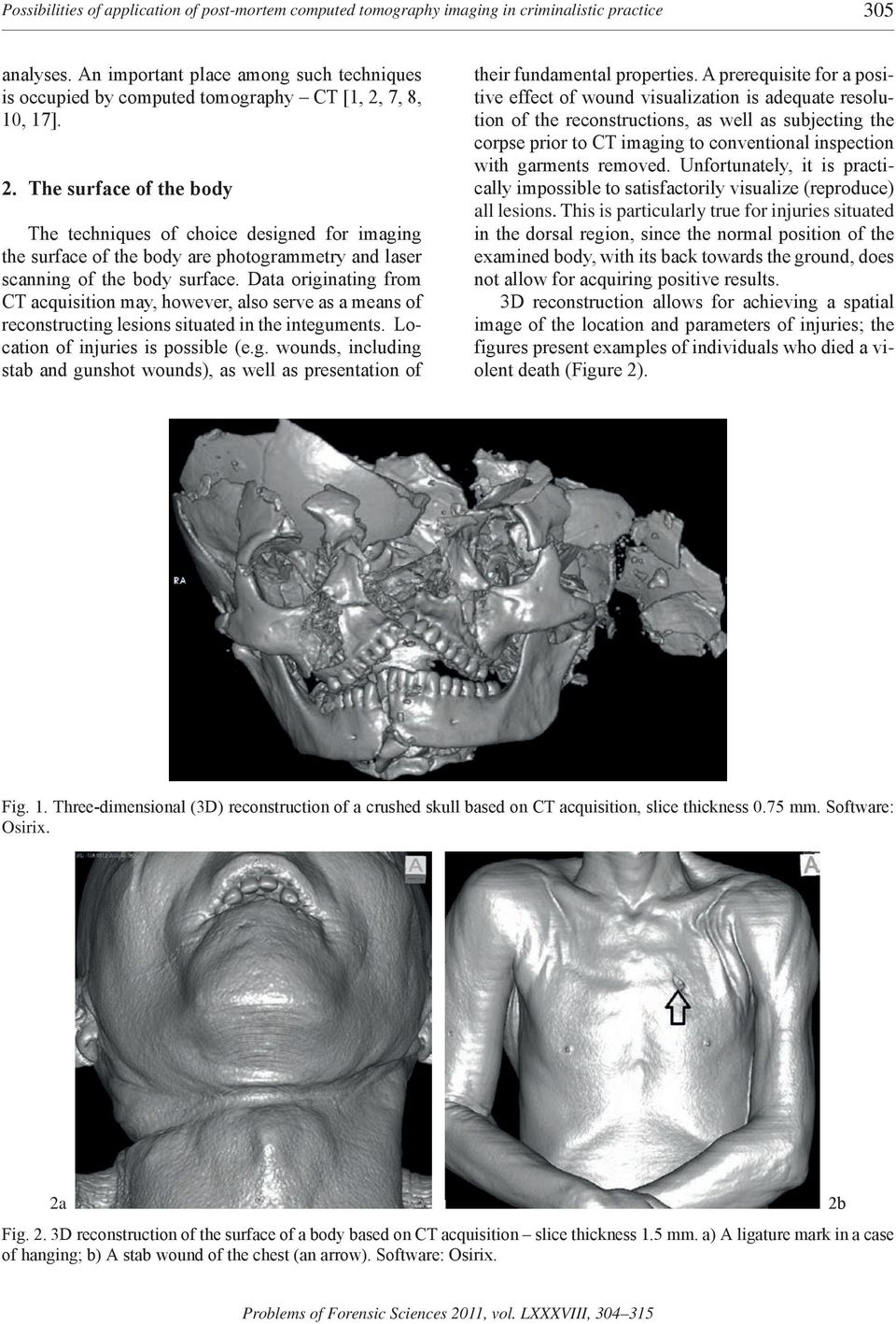 7, 8, 10, 17]. 2. The surface of the body The techniques of choice designed for imaging the surface of the body are photogrammetry and laser scanning of the body surface.