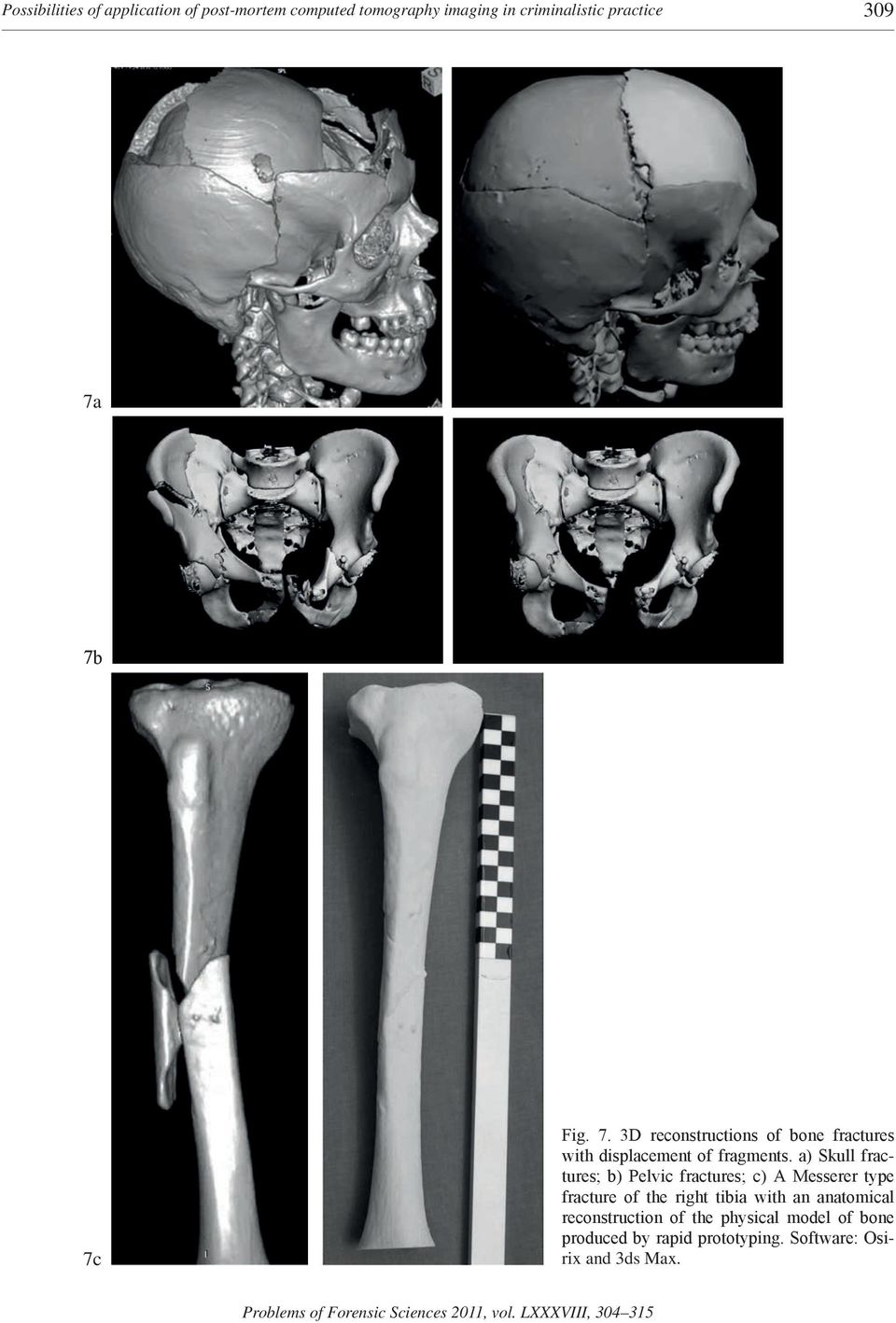 a) Skull fractures; b) Pelvic fractures; c) A Messerer type fracture of the right tibia with an