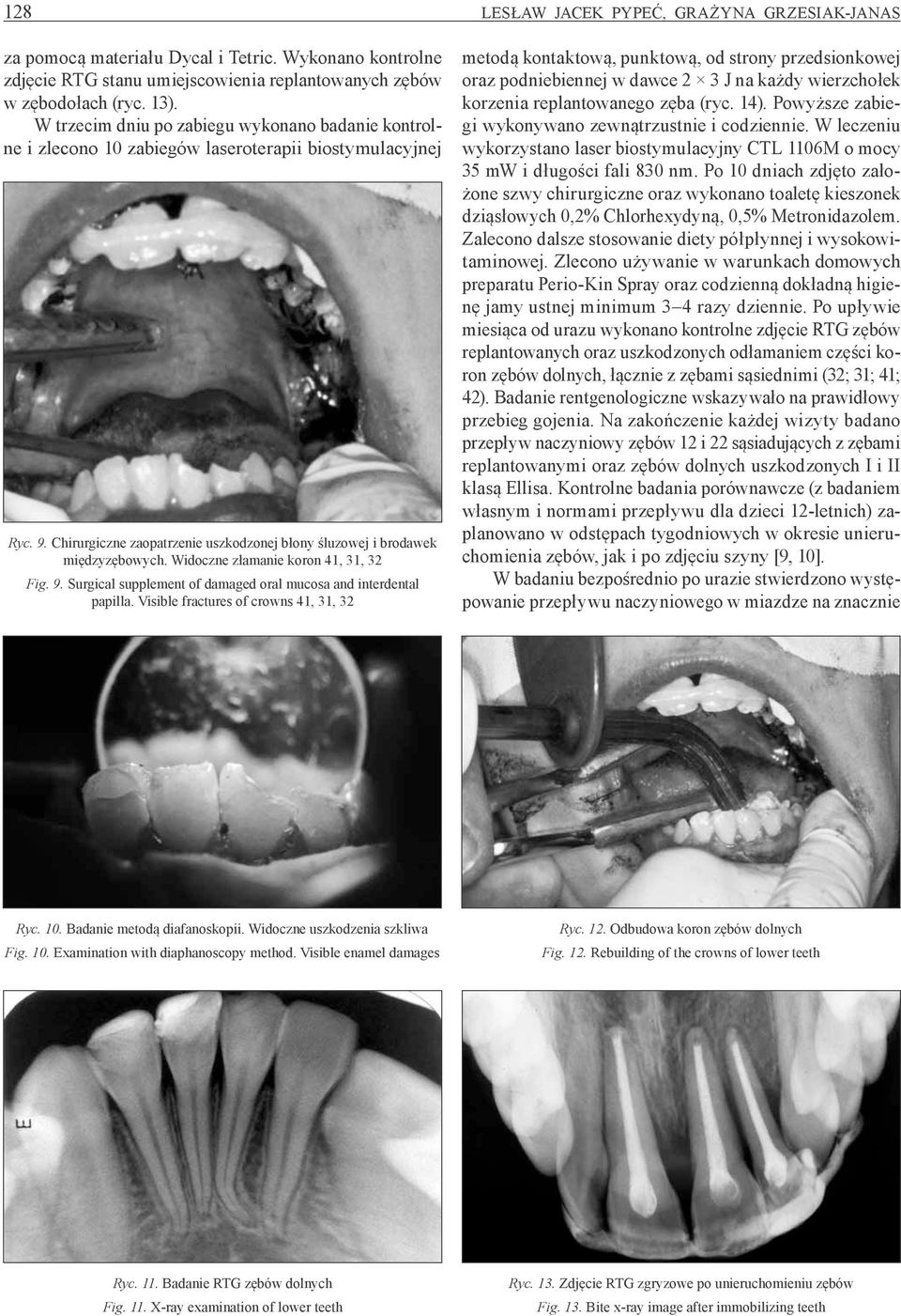 Widoczne złamanie koron 41, 31, 32 Fig. 9. Surgical supplement of damaged oral mucosa and interdental papilla.