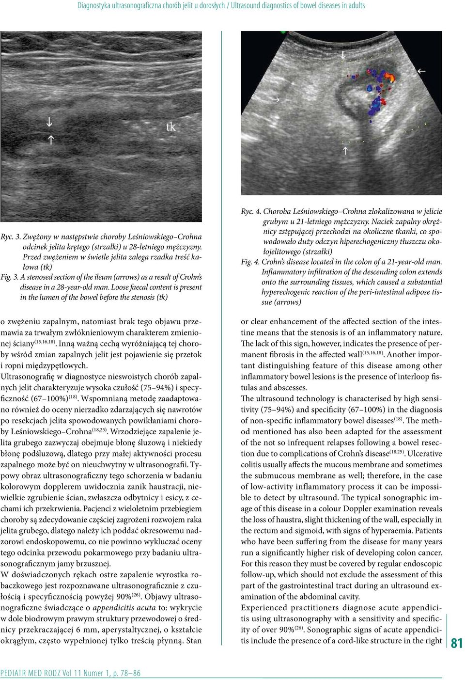 A stenosed section of the ileum (arrows) as a result of Crohn s disease in a 28-year-old man.