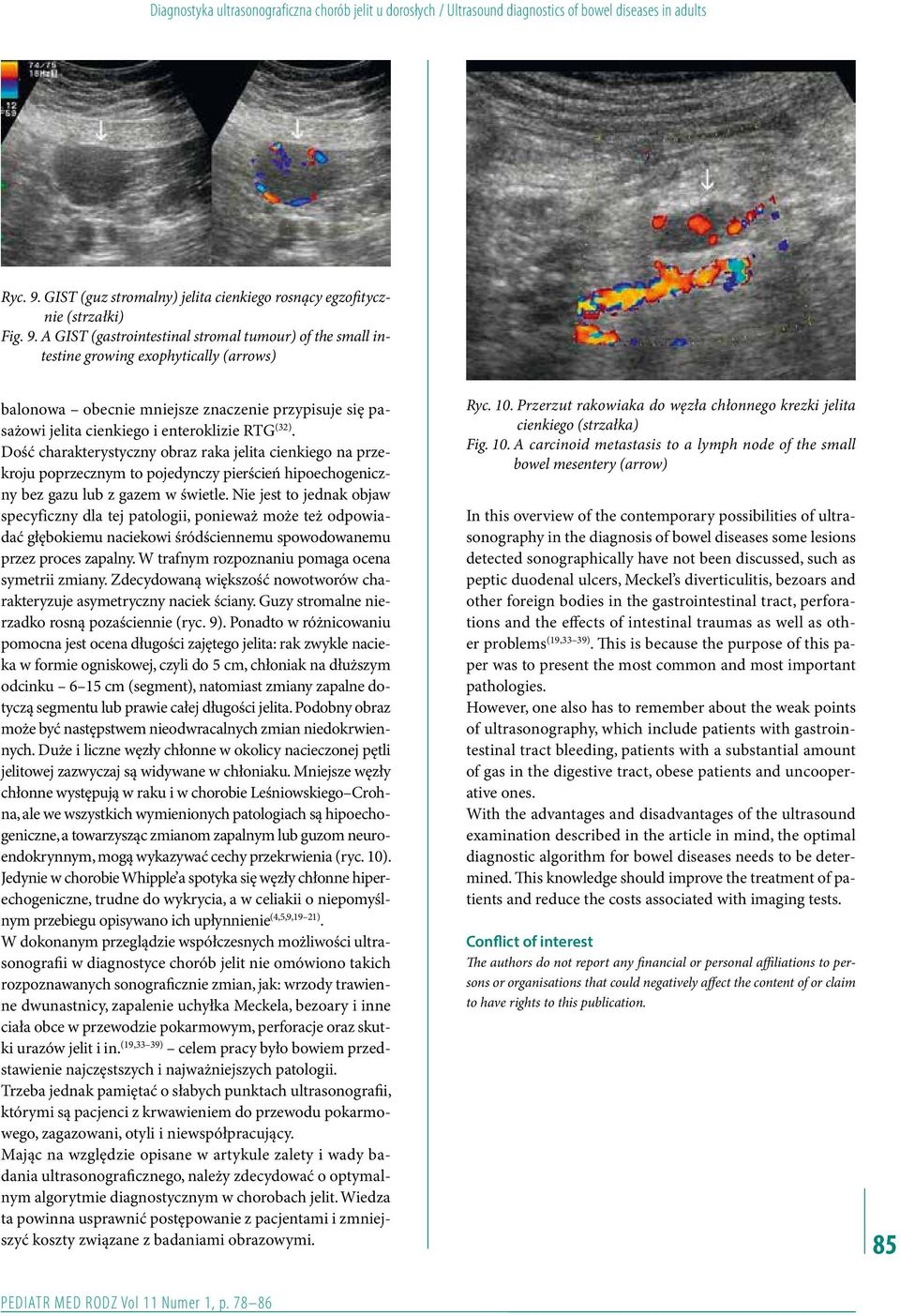 A GIST (gastrointestinal stromal tumour) of the small intestine growing exophytically (arrows) balonowa obecnie mniejsze znaczenie przypisuje się pasażowi jelita cienkiego i enteroklizie RTG (32).
