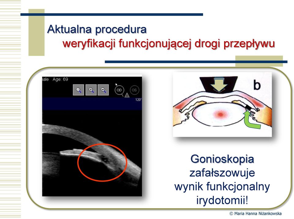 drogi przepływu Gonioskopia