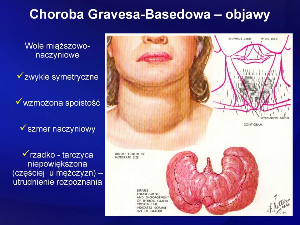 spoistość szmer naczyniowy rzadko - tarczyca