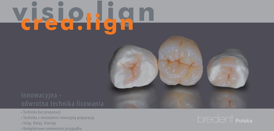z minimalnie inwazyjną preparacją Inlay,
