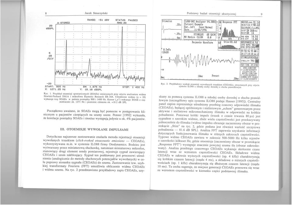 25 Hz Ryc. 2. BW: 1.875 Hz Y: 18. 18 dbspl STP: Ryc. 1. Przykład otoemisji spontanicznych (SAEs) zmierzonych przy użyciu analizatora widma Hewlett-Packard 3561A i mikrofonu Etymotic Research ER-IA.