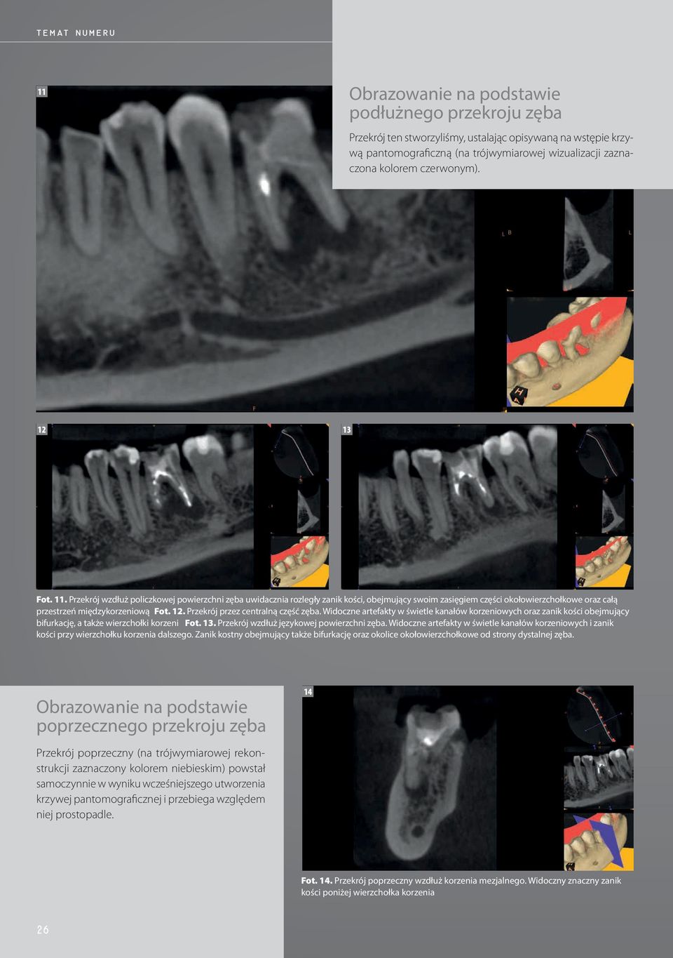 Przekrój wzdłuż policzkowej powierzchni zęba uwidacznia rozległy zanik kości, obejmujący swoim zasięgiem części okołowierzchołkowe oraz całą przestrzeń międzykorzeniową Fot. 12.