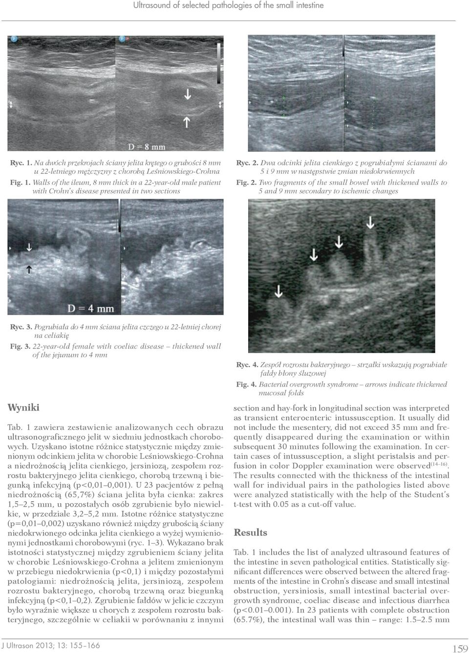 Two fragments of the small bowel with thickened walls to 5 and 9 mm secondary to ischemic changes Ryc. 3. Pogrubiała do 4 mm ściana jelita czczego u 22 letniej chorej na celiakię Fig. 3. 22 year old female with coeliac disease thickened wall of the jejunum to 4 mm Wyniki Tab.