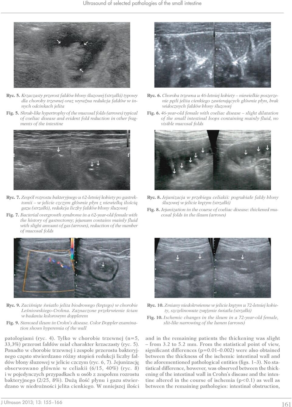 Shrub like hypertrophy of the mucosal folds (arrows) typical of coeliac disease and evident fold reduction in other fragments of the intestine Ryc. 6.