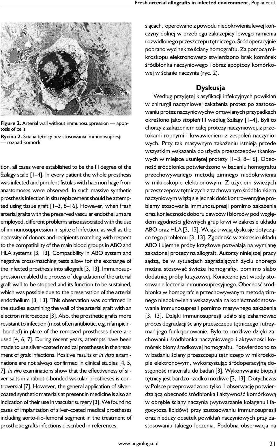 Za pomocą mikroskopu elektronowego stwierdzono brak komórek śródbłonka naczyniowego i obraz apoptozy komórkowej w ścianie naczynia (ryc. 2). Figure 2.