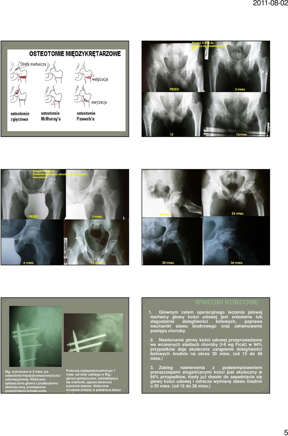 Podczas następnej kontroli po 7 mies. od daty zabiegu w Rtg.: głowa spłaszczona, oddzielający się martwak, szpara stawowa pozornie szersza. Widoczne wczesne zmiany w panewce stawu biodrowego 1.