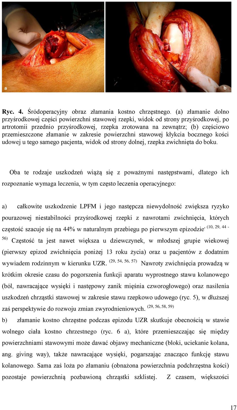 złamanie w zakresie powierzchni stawowej kłykcia bocznego kości udowej u tego samego pacjenta, widok od strony dolnej, rzepka zwichnięta do boku.