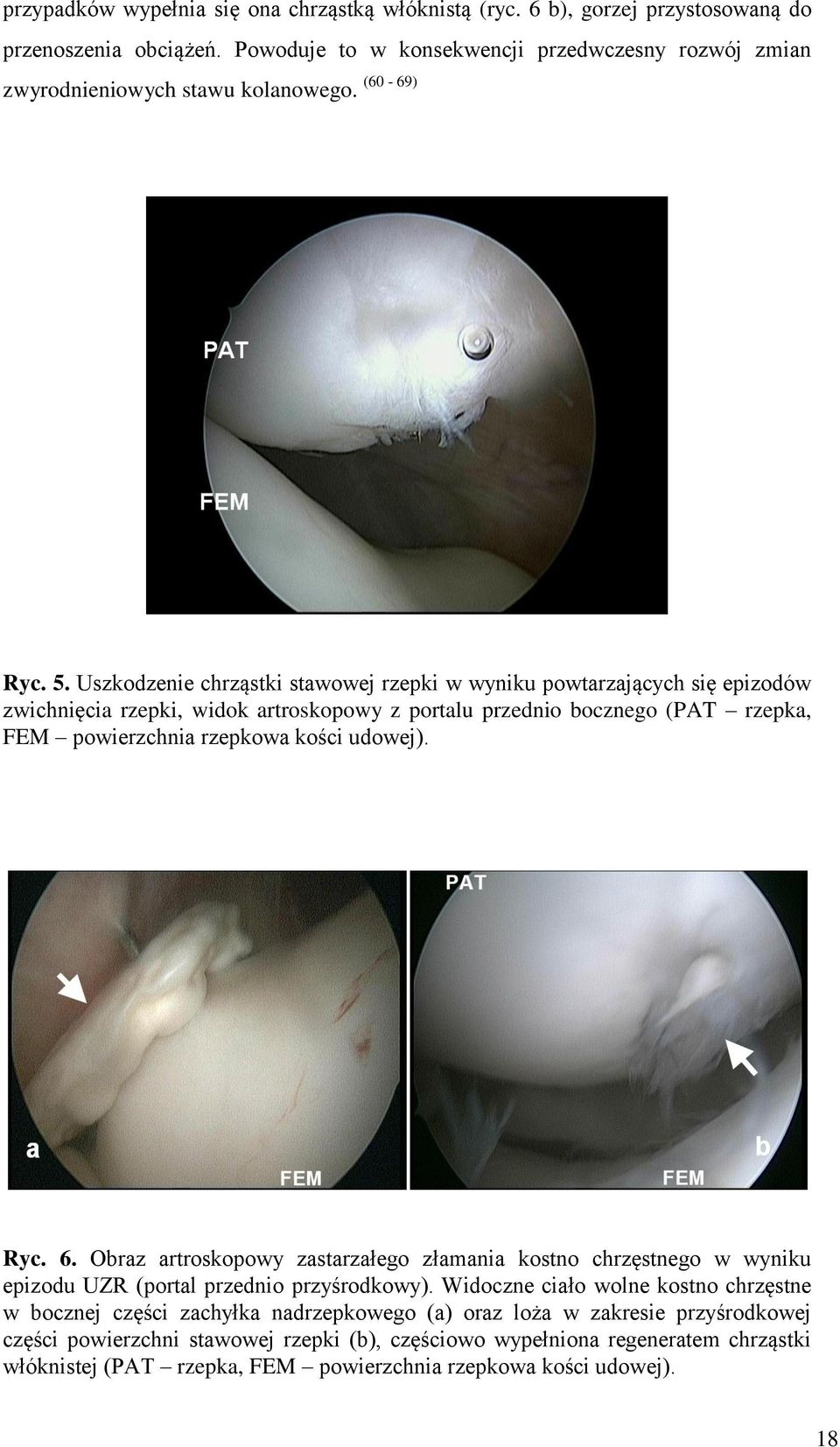 Uszkodzenie chrząstki stawowej rzepki w wyniku powtarzających się epizodów zwichnięcia rzepki, widok artroskopowy z portalu przednio bocznego (PAT rzepka, FEM powierzchnia rzepkowa kości udowej).