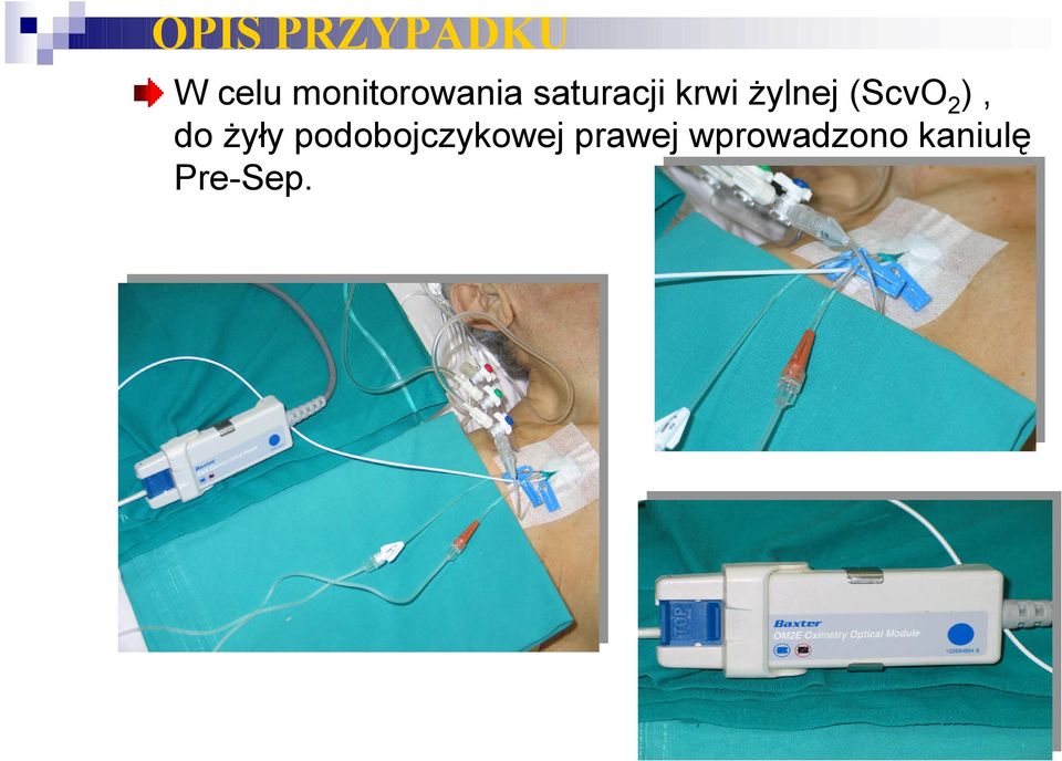 żylnej (ScvO 2 ), do żyły