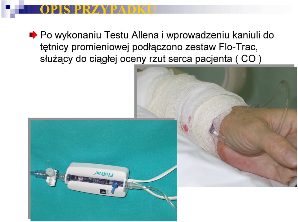 promieniowej podłączono zestaw Flo-Trac,