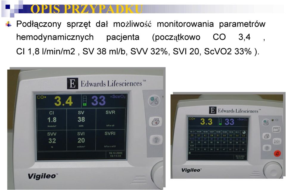 hemodynamicznych pacjenta (początkowo CO