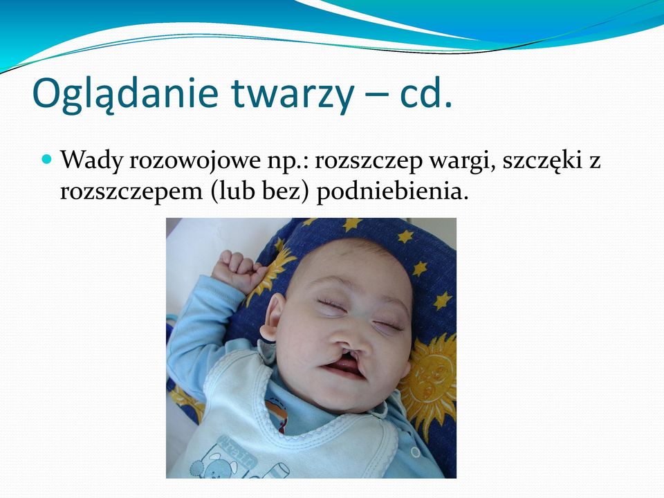 : rozszczep wargi,