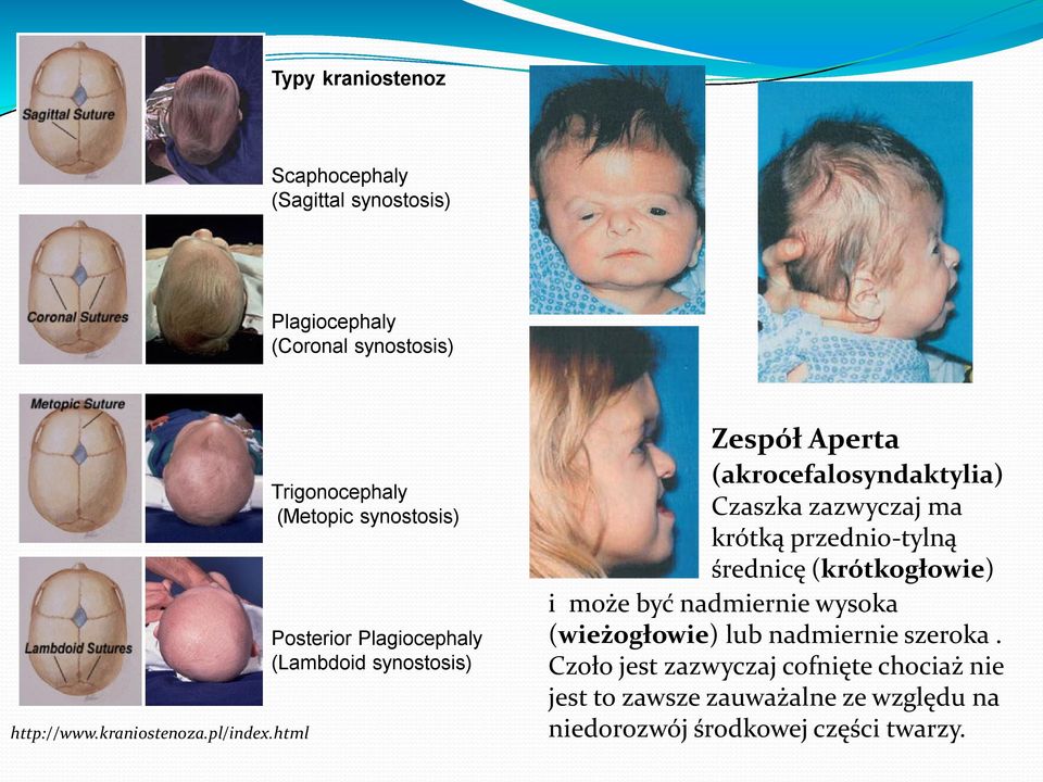 Czaszka zazwyczaj ma krótką przednio-tylną średnicę (krótkogłowie) i może być nadmiernie wysoka (wieżogłowie) lub nadmiernie