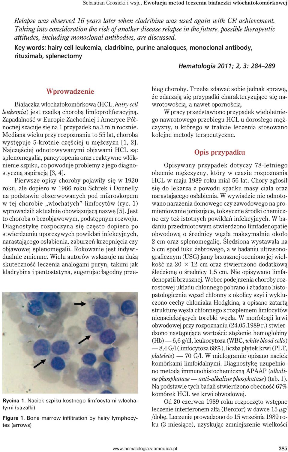 Key words: hairy cell leukemia, cladribine, purine analoques, monoclonal antibody, rituximab, splenectomy Hematologia 2011; 2, 3: 284 289 Wprowadzenie Rycina 1.