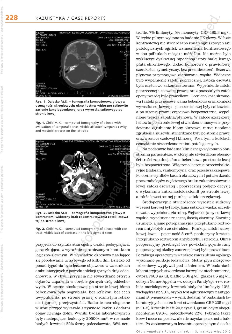 computed tomography of a head with contrast; visible lack of contrast in the left sigmoid sinus przyjęcia do szpitala stan ogólny ciężki, podsypiająca, gorączkująca, z wyraźnie ograniczonym kontaktem