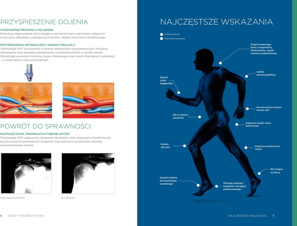 PRZYSPIESZENIE METABOLIZMU I MIKROCYRKULACJI Technologia SWT przyspiesza usuwanie metabolitów nocyceptywnych, zwiększa utlenowanie oraz poprawia zaopatrzenie uszkodzonej tkanki w źródła energii.