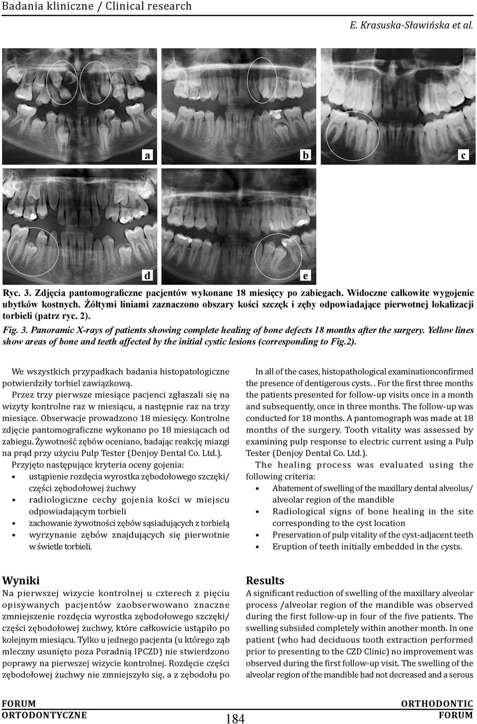 Panoramic X-rays of patients showing complete healing of bone defects 18 months after the surgery.