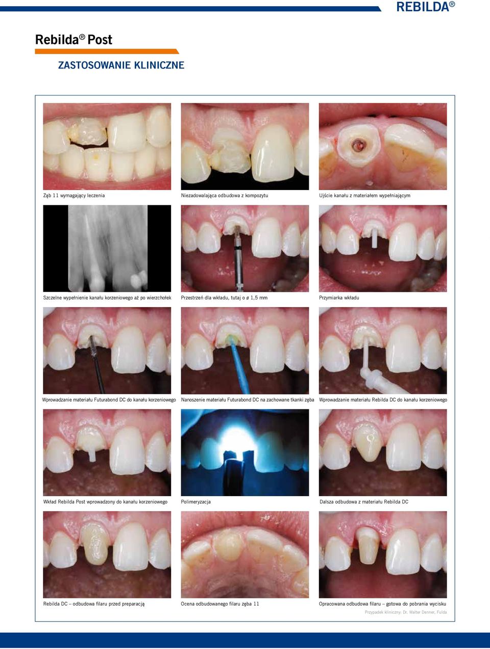 DC na zachowane tkanki zęba Wprowadzanie materiału Rebilda DC do kanału korzeniowego Wkład Rebilda Post wprowadzony do kanału korzeniowego Polimeryzacja Dalsza odbudowa z materiału
