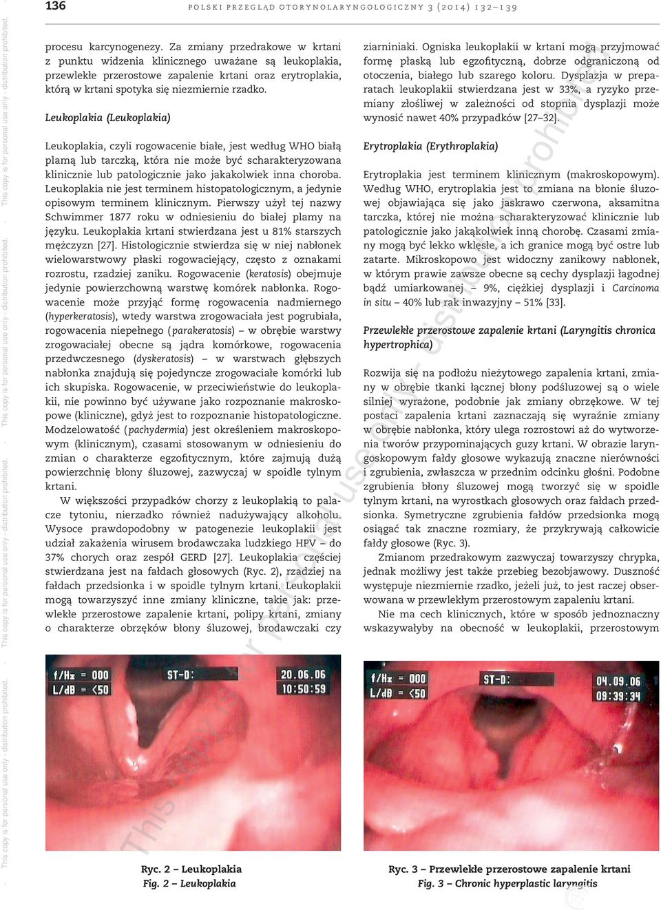 Leukoplakia (Leukoplakia) Leukoplakia, czyli rogowacenie białe, jest według WHO białą plamą lub tarczką, która nie może być scharakteryzowana klinicznie lub patologicznie jako jakakolwiek inna
