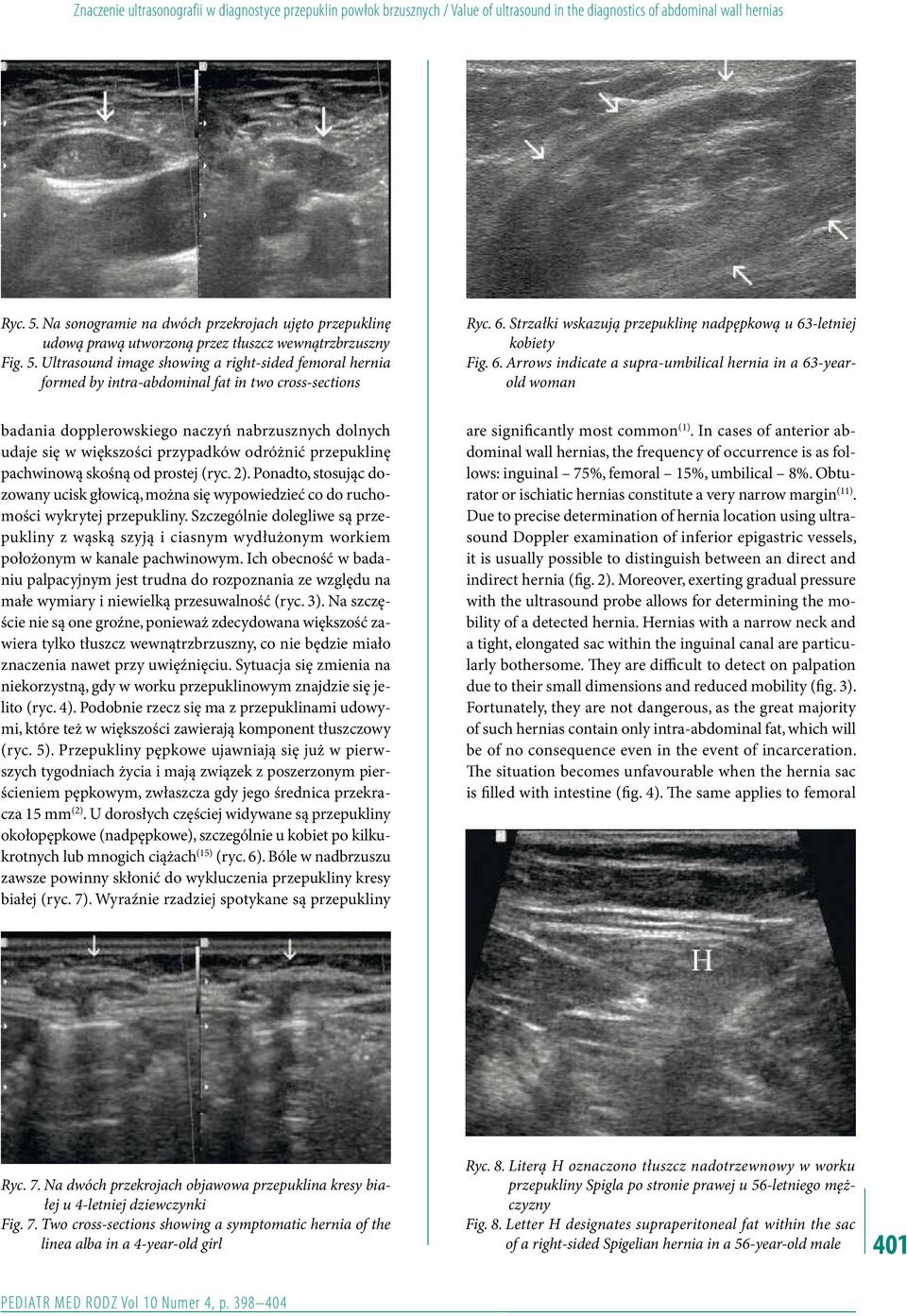 Ultrasound image showing a right-sided femoral hernia formed by intra-abdominal fat in two cross-sections Ryc. 6.
