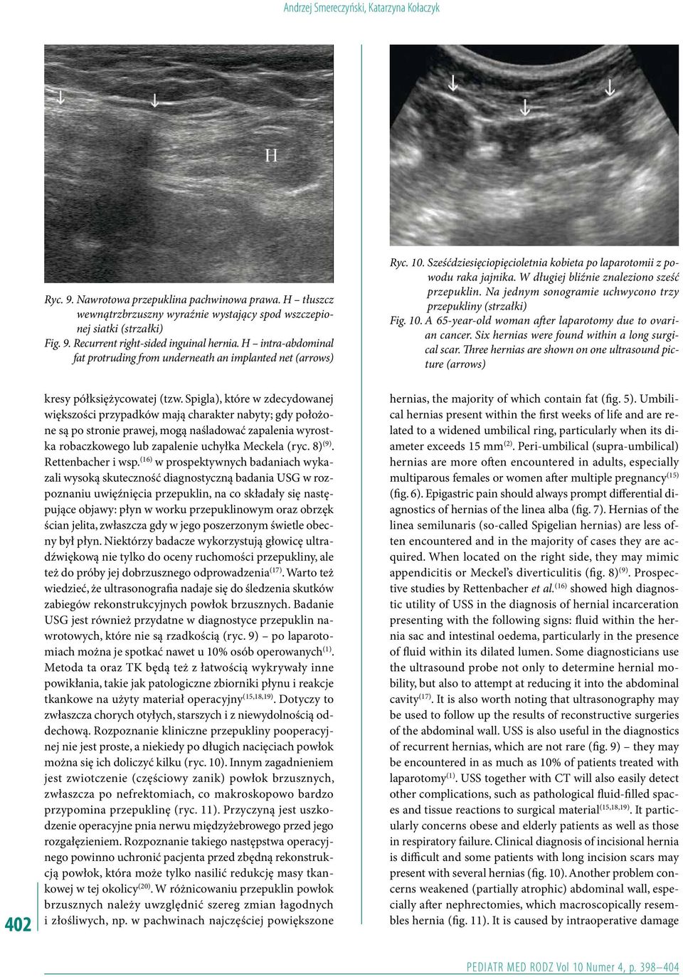 W długiej bliźnie znaleziono sześć przepuklin. Na jednym sonogramie uchwycono trzy przepukliny (strzałki) Fig. 10. A 65-year-old woman after laparotomy due to ovarian cancer.