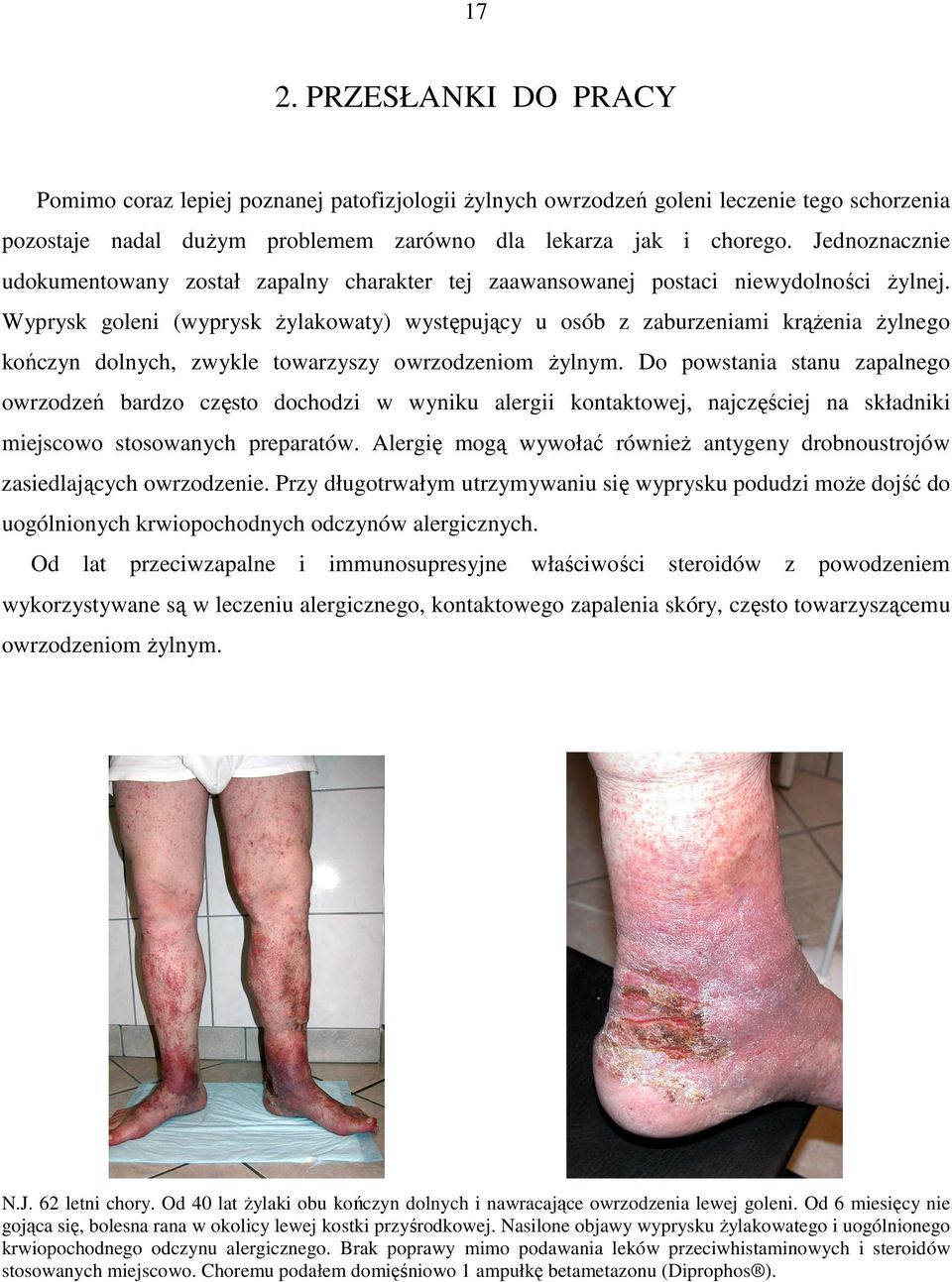 Wyprysk goleni (wyprysk żylakowaty) występujący u osób z zaburzeniami krążenia żylnego kończyn dolnych, zwykle towarzyszy owrzodzeniom żylnym.