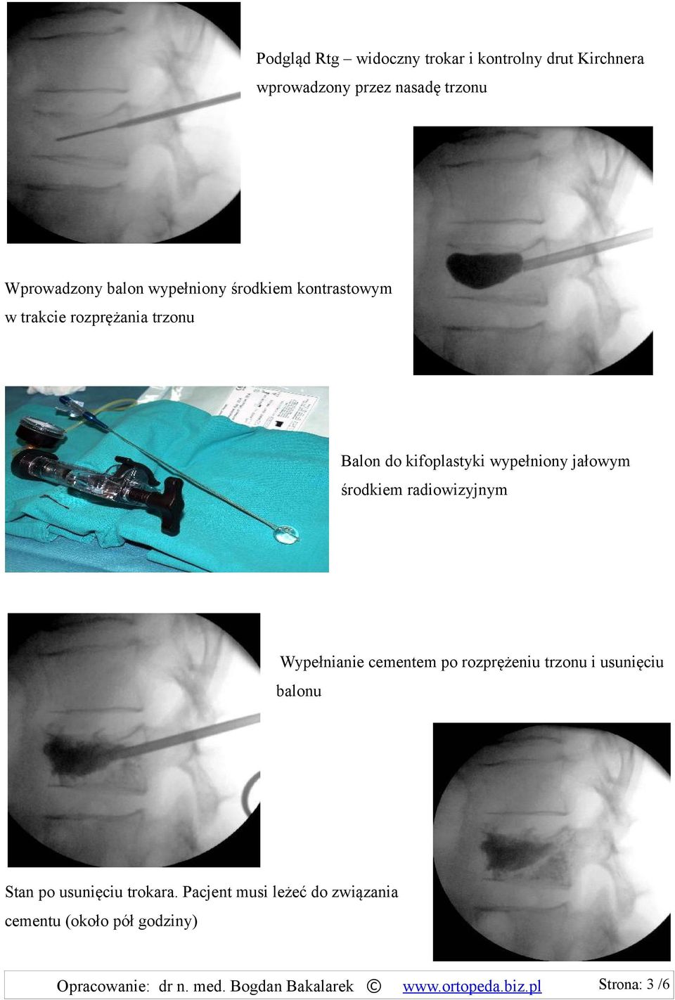 radiowizyjnym Wypełnianie cementem po rozprężeniu trzonu i usunięciu balonu Stan po usunięciu trokara.