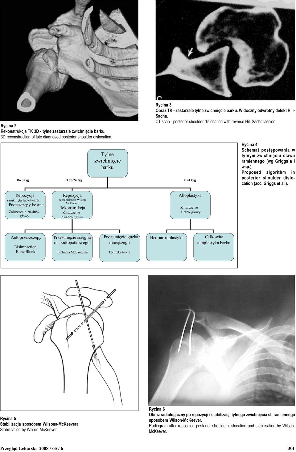 Rycina 4 Schemat postêpowania w tylnym zwichniêciu stawu ramiennego (wg Griggs`a i wsp.). Proposed algorithm in posterior shoulder dislocation (acc. Griggs et al.). zamkniêta lub otwarta.
