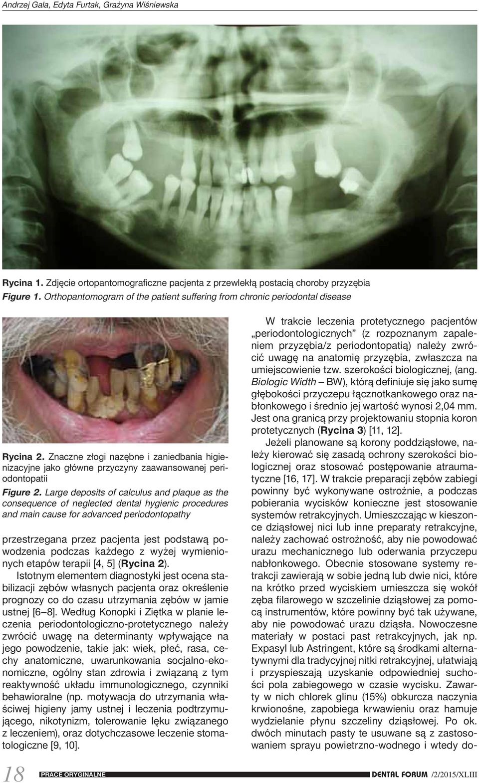 Large deposits of calculus and plaque as the consequence of neglected dental hygienic procedures and main cause for advanced periodontopathy przestrzegana przez pacjenta jest podstawą powodzenia