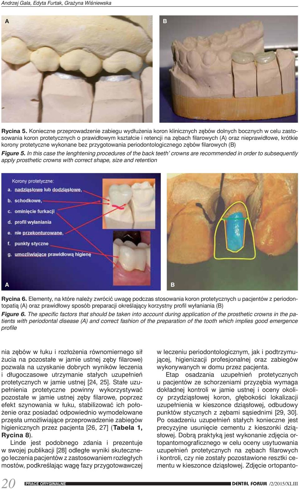 nieprawidłowe, krótkie korony protetyczne wykonane bez przygotowania periodontologicznego zębów filarowych (B) Figure 5.