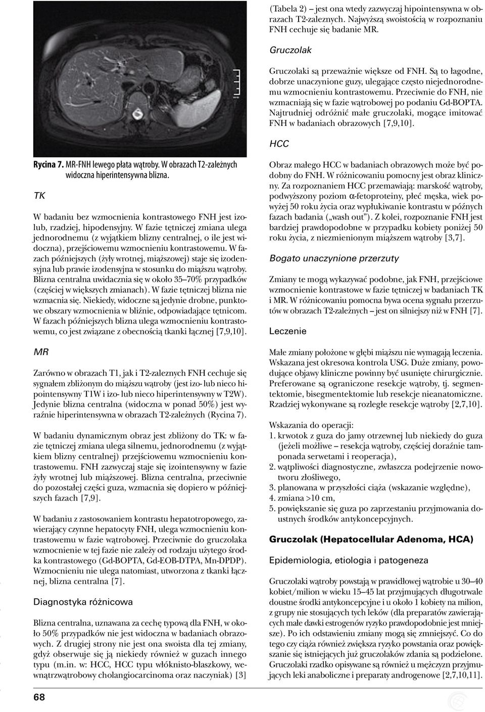 Najtrudniej odróżnić małe gruczolaki, mogące imitować FNH w badaniach obrazowych [7,9,10]. HCC Rycina 7. MR-FNH lewego płata wątroby. W obrazach T2-zależnych widoczna hiperintensywna blizna.