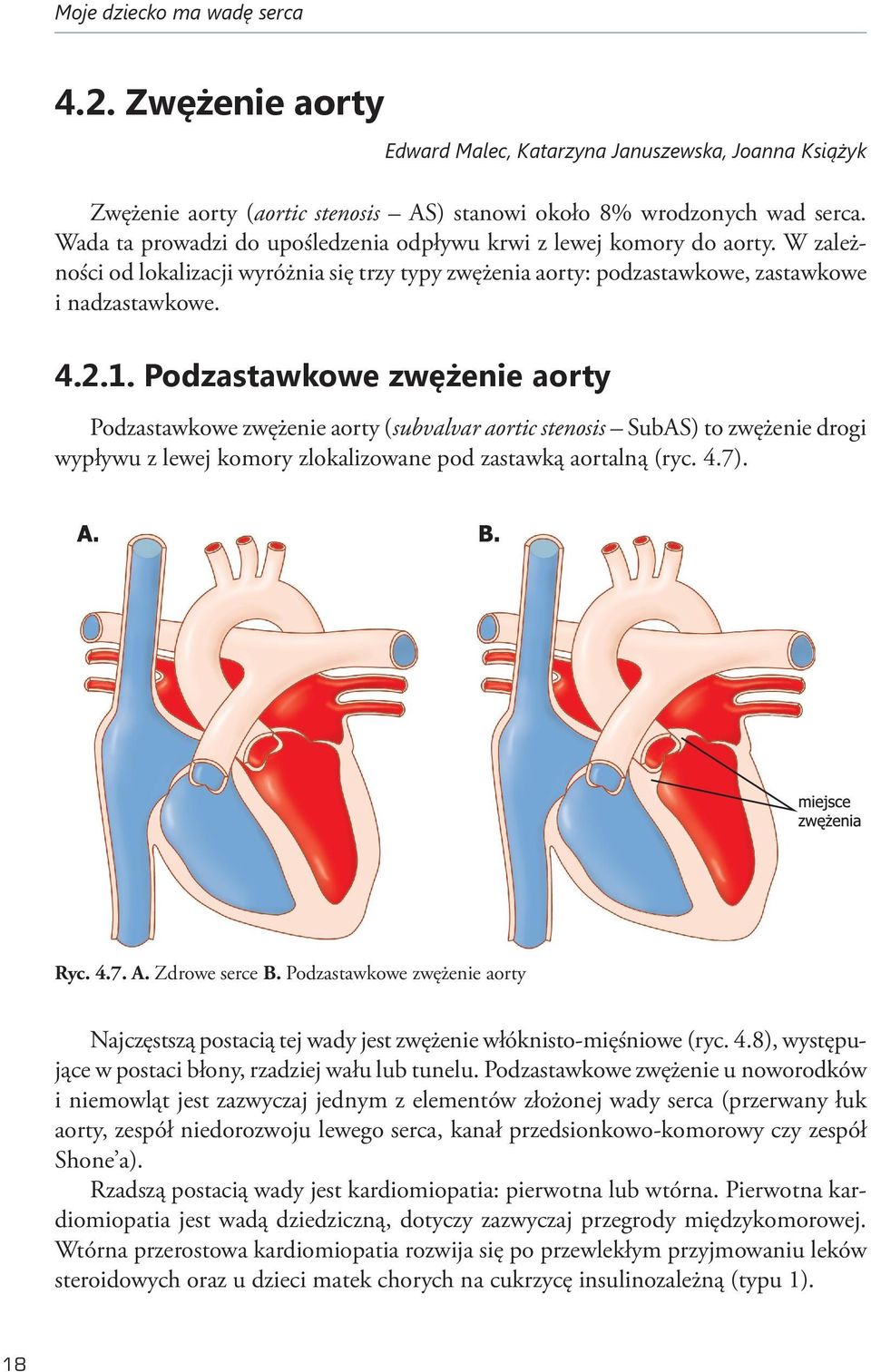 Podzastawkowe zwężenie aorty Podzastawkowe zwężenie aorty (subvalvar aortic stenosis SubAS) to zwężenie drogi wypływu z lewej komory zlokalizowane pod zastawką aortalną (ryc. 4.7). Ryc. 4.7. A.